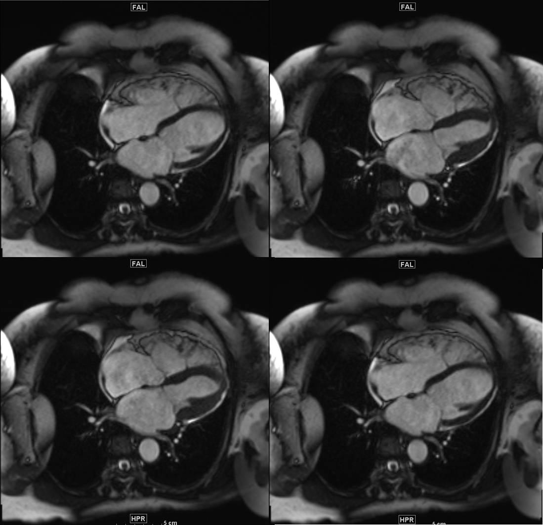 71/F, RV dilatation on TTE
