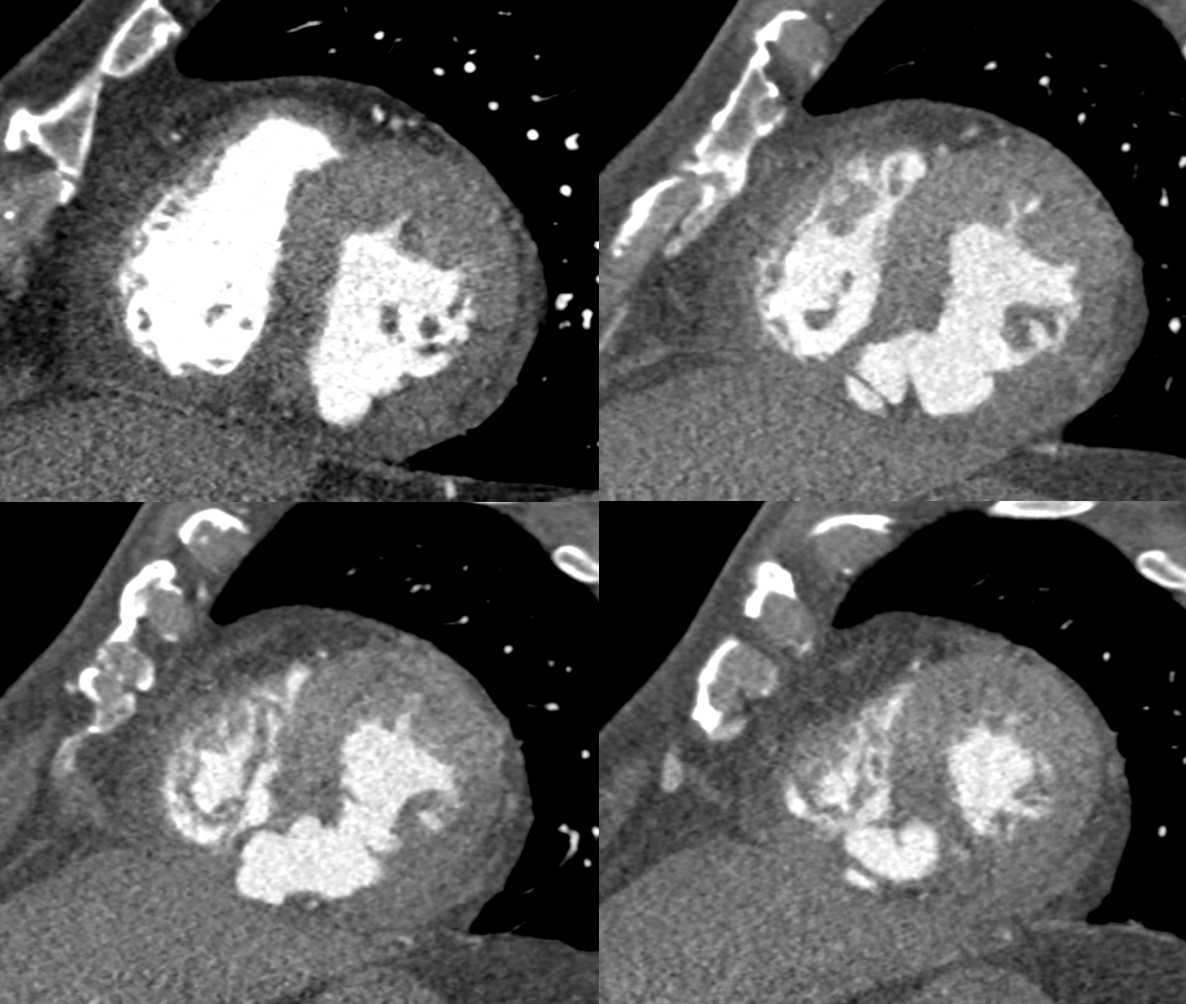 72/M, chest pain for 3 days and s/p PCI in RCA 3 days ago