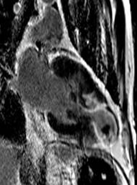 67/F, recent aggravation of chest pain