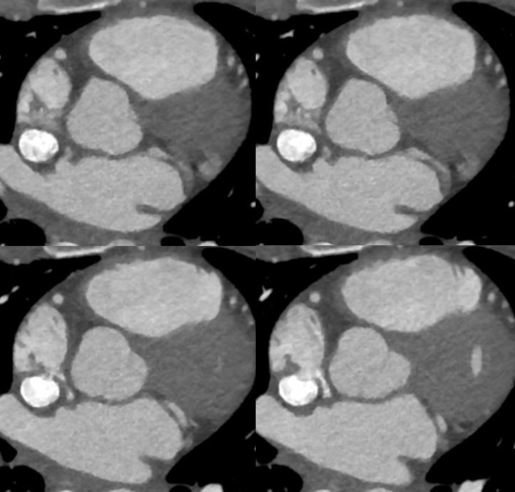 23/F, incidental abnormality detected on heart CT