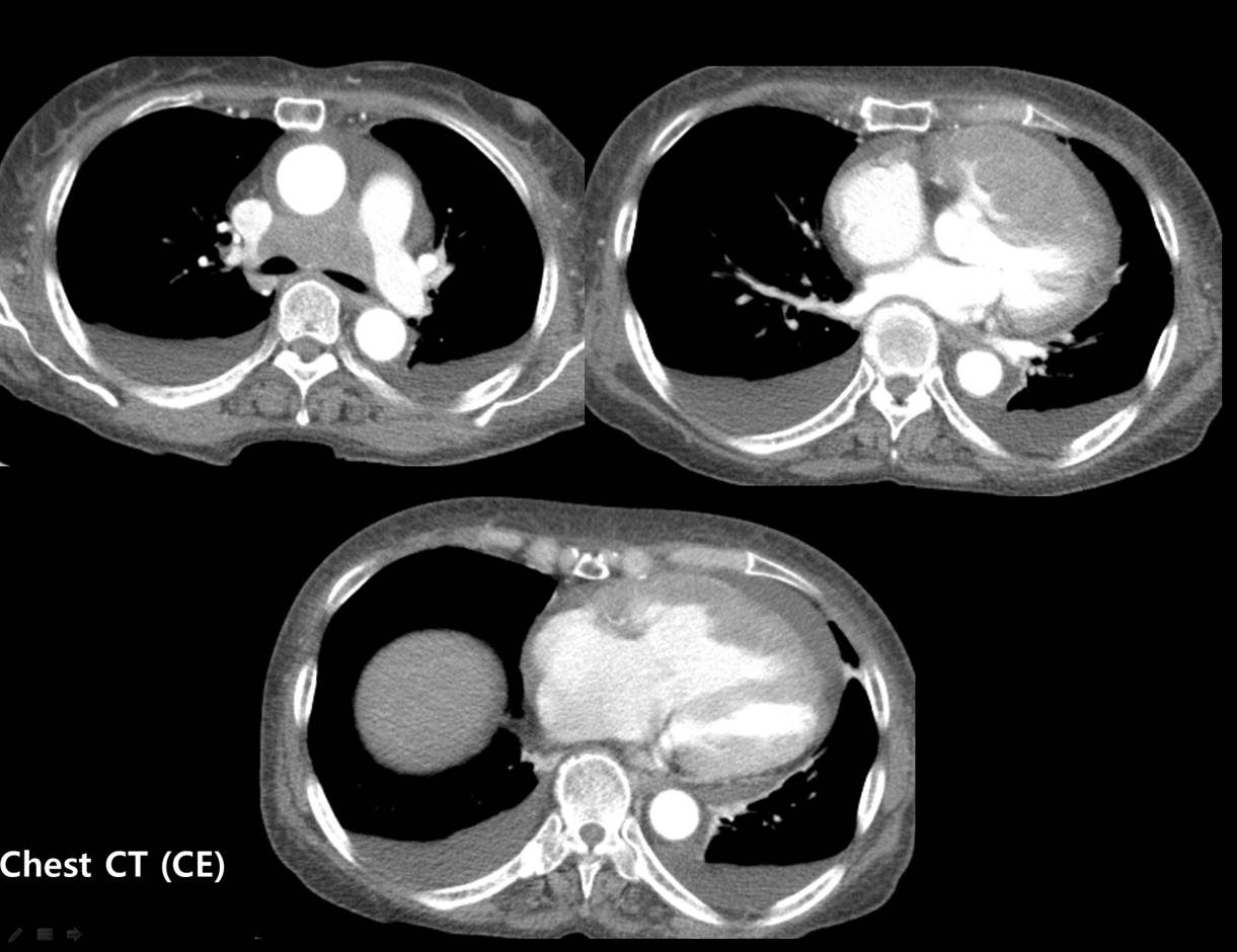 74/F, chest pain for 5 days