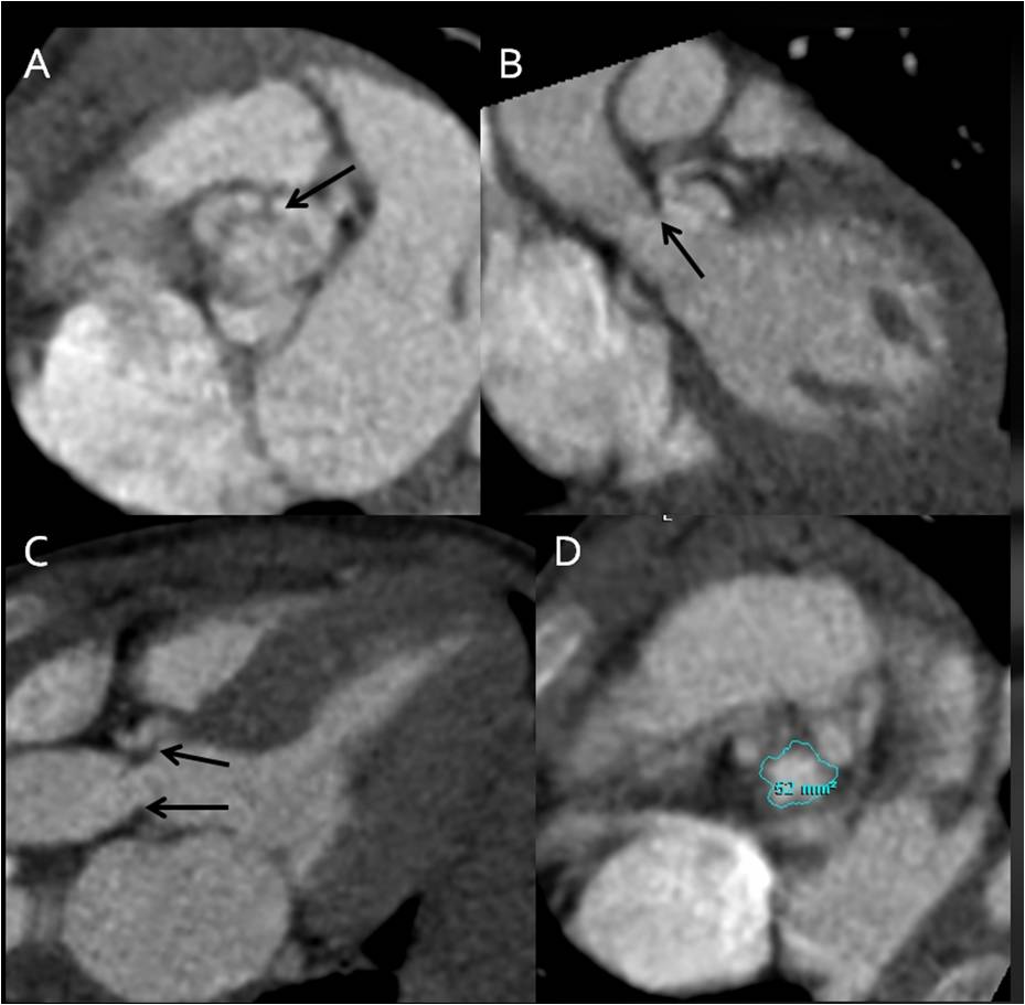 4/F, cardiac murmur