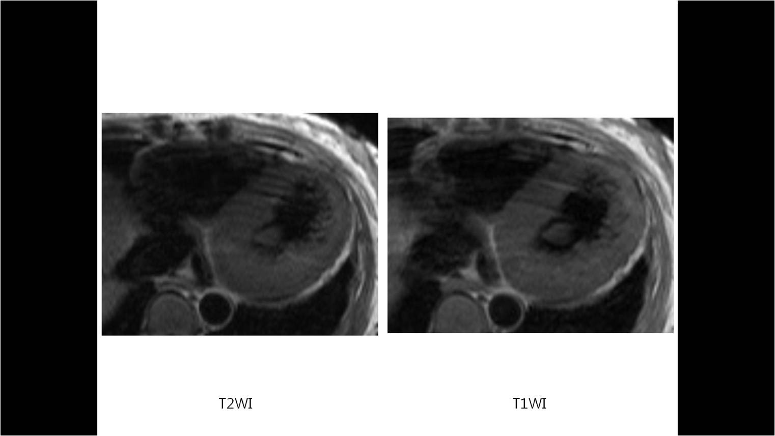 64/F, dyspnea on exertion