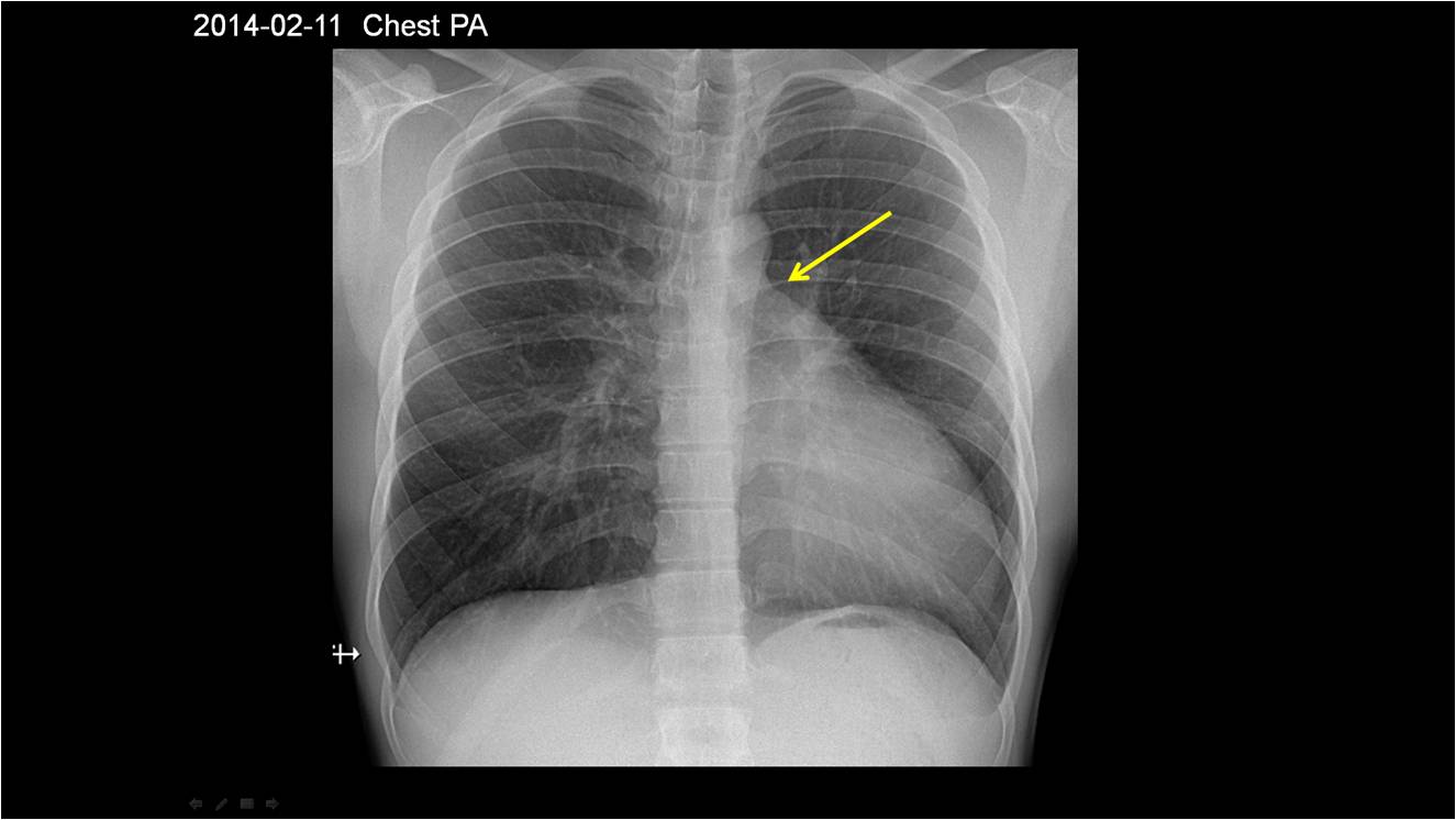 Heart 21 / M, Cardiomegaly