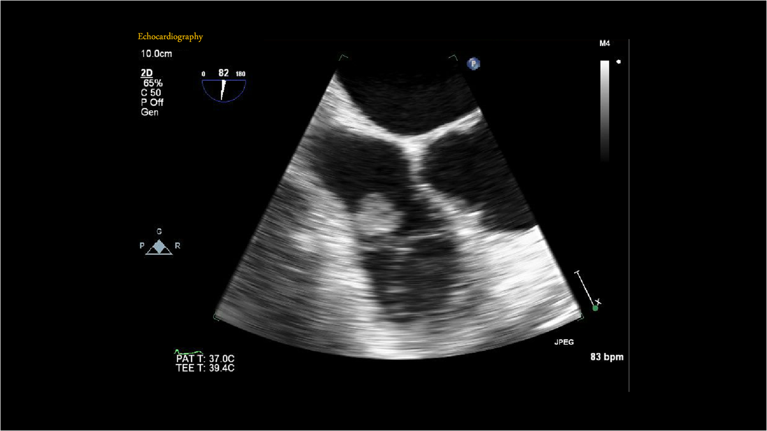 Heart   55 / M,  Incidental TV mass PHx