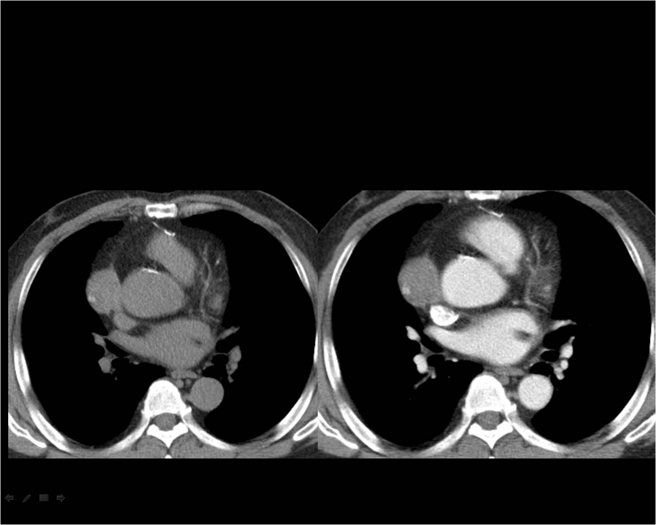 Heart 53 / M, Incidental abnormality detected on CT