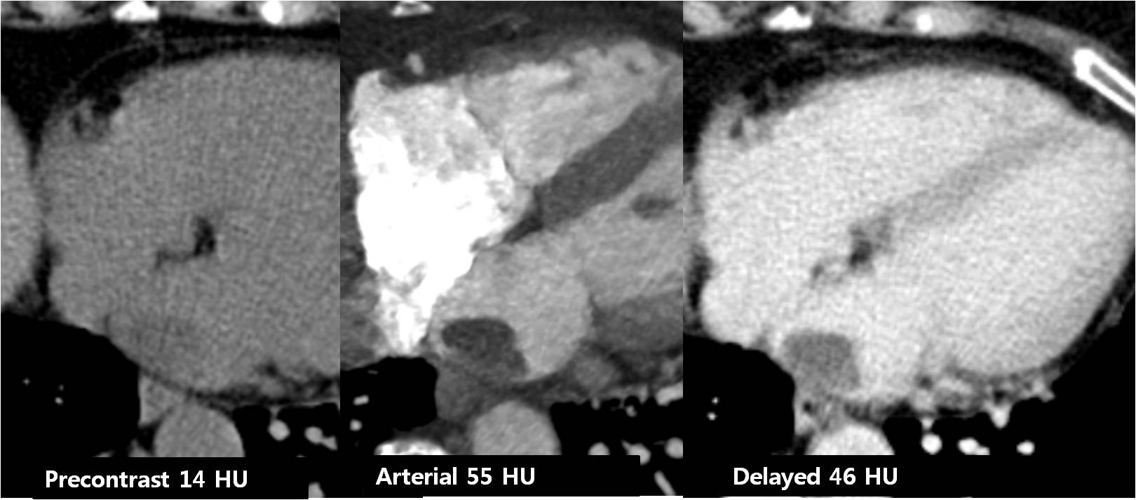 Heart   74 / F,  incidental LA mass PHx. appendiceal mucocele s/p appendectomy, 9YA