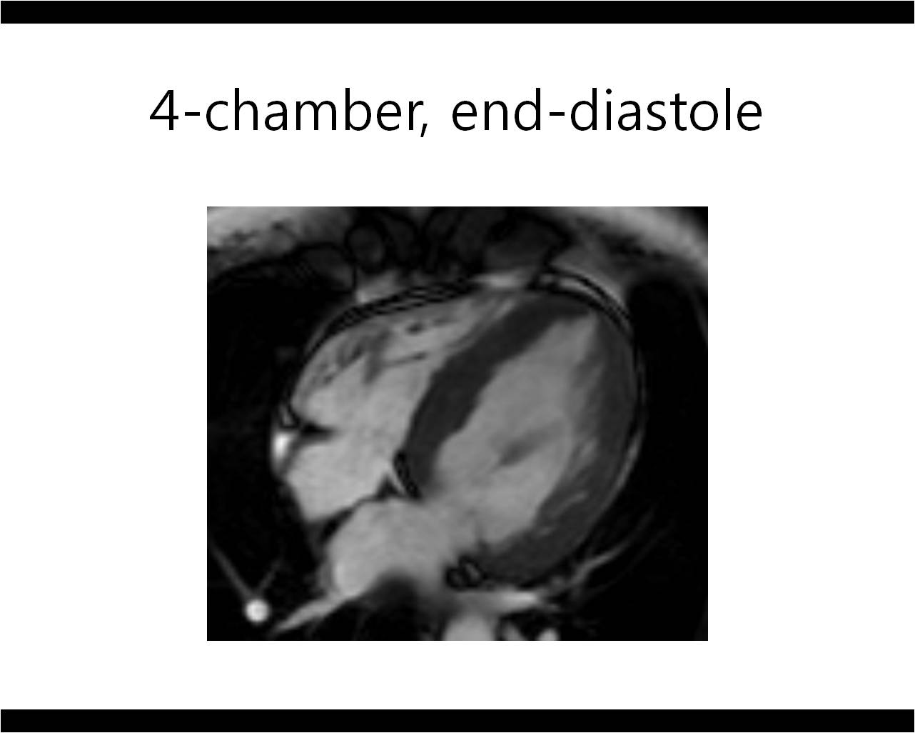Heart   44 / F,  Syncope during mountain climbing