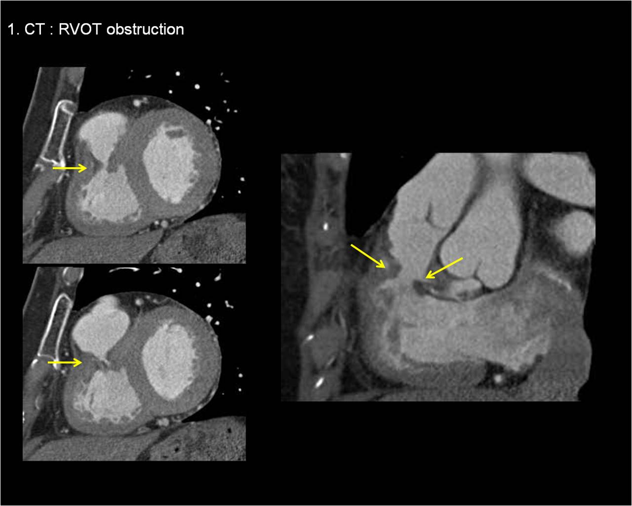 Heart   71 / F,  dyspnea
