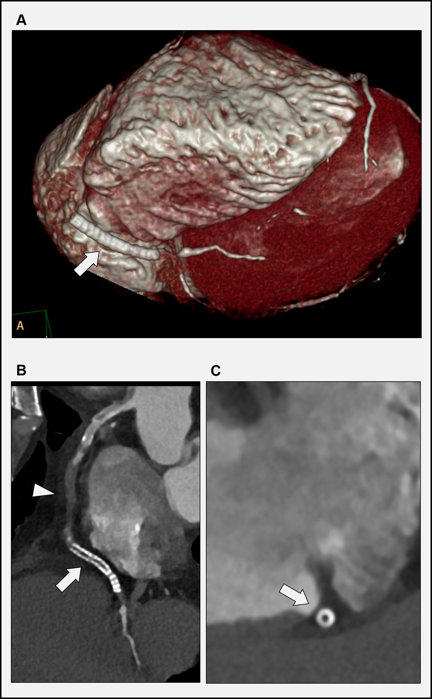 54/M, implanted coronary stent  