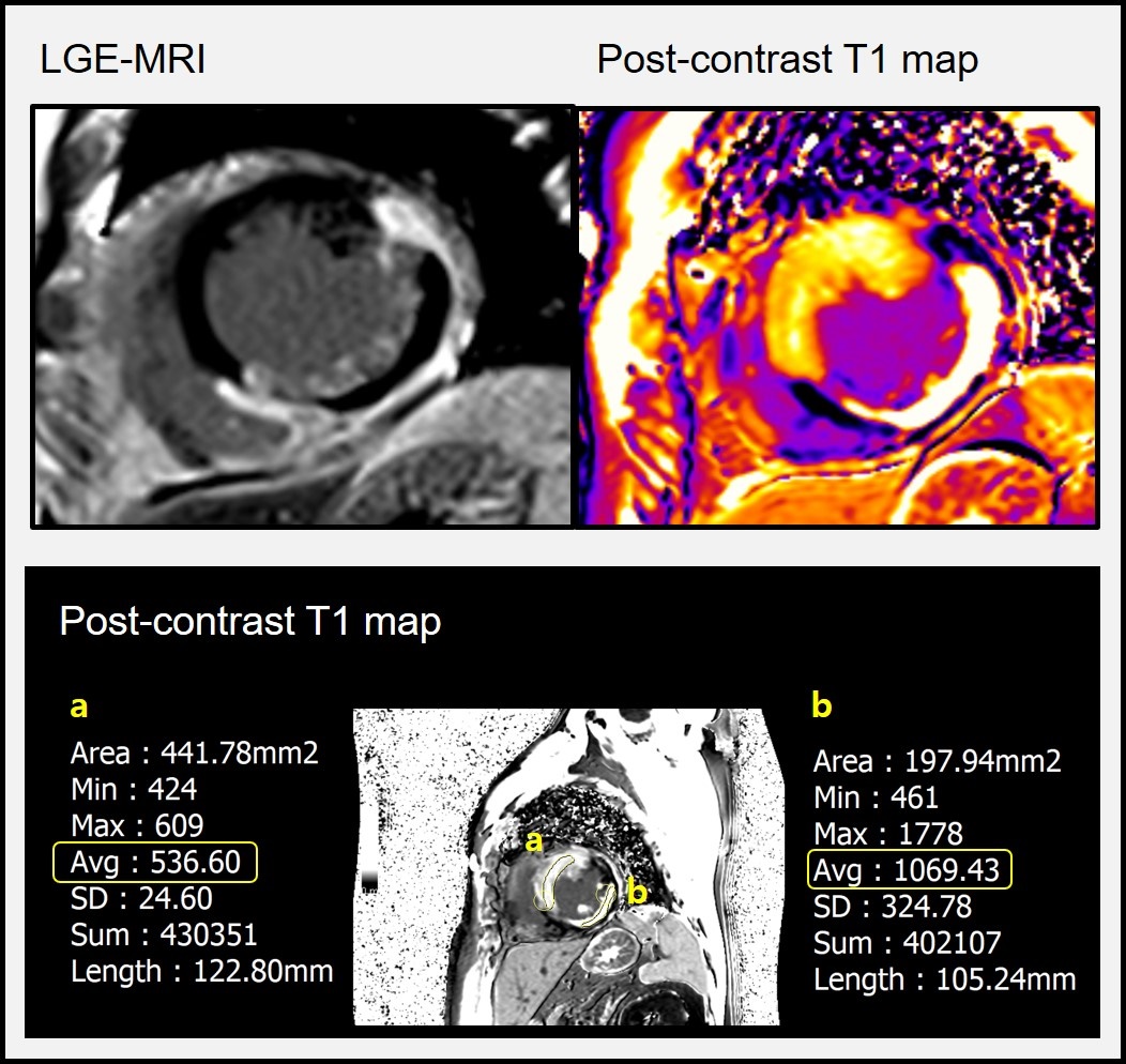 57/M, microvascular obstruction