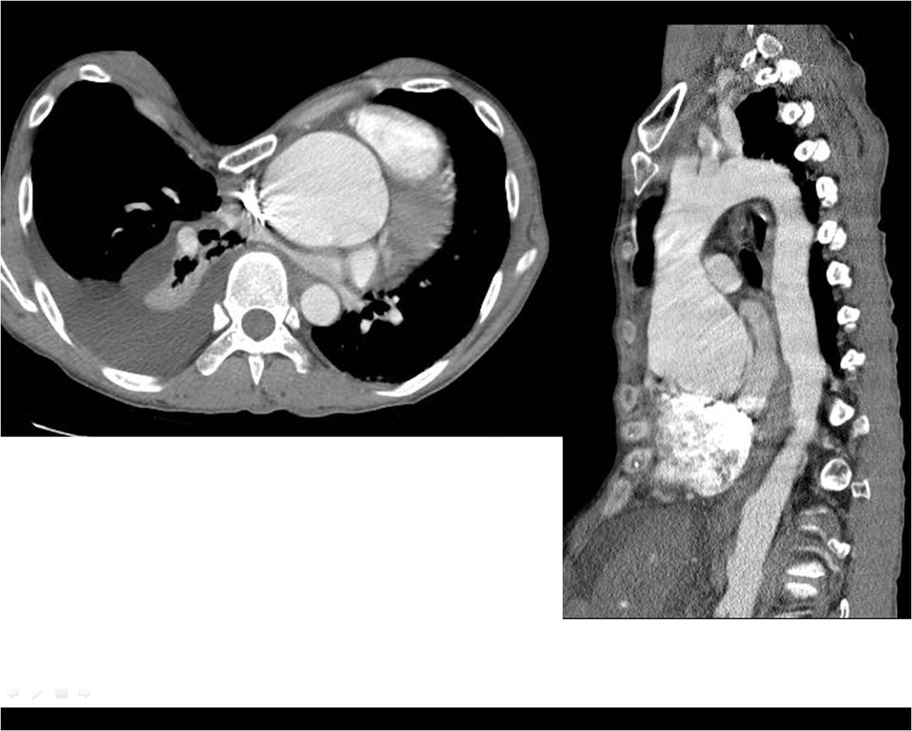 Aorta & pulmonary artery 42 / M, Dyspnea