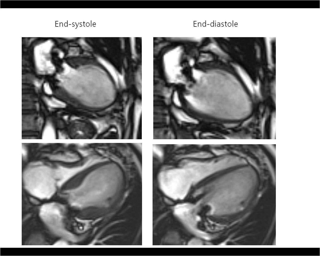 Heart 53 / F, bradycardia (50-60 bpm) 5 days after resection for left atrial sarcoma