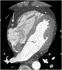 Heart   43 / M,  screening coronary CT angiography