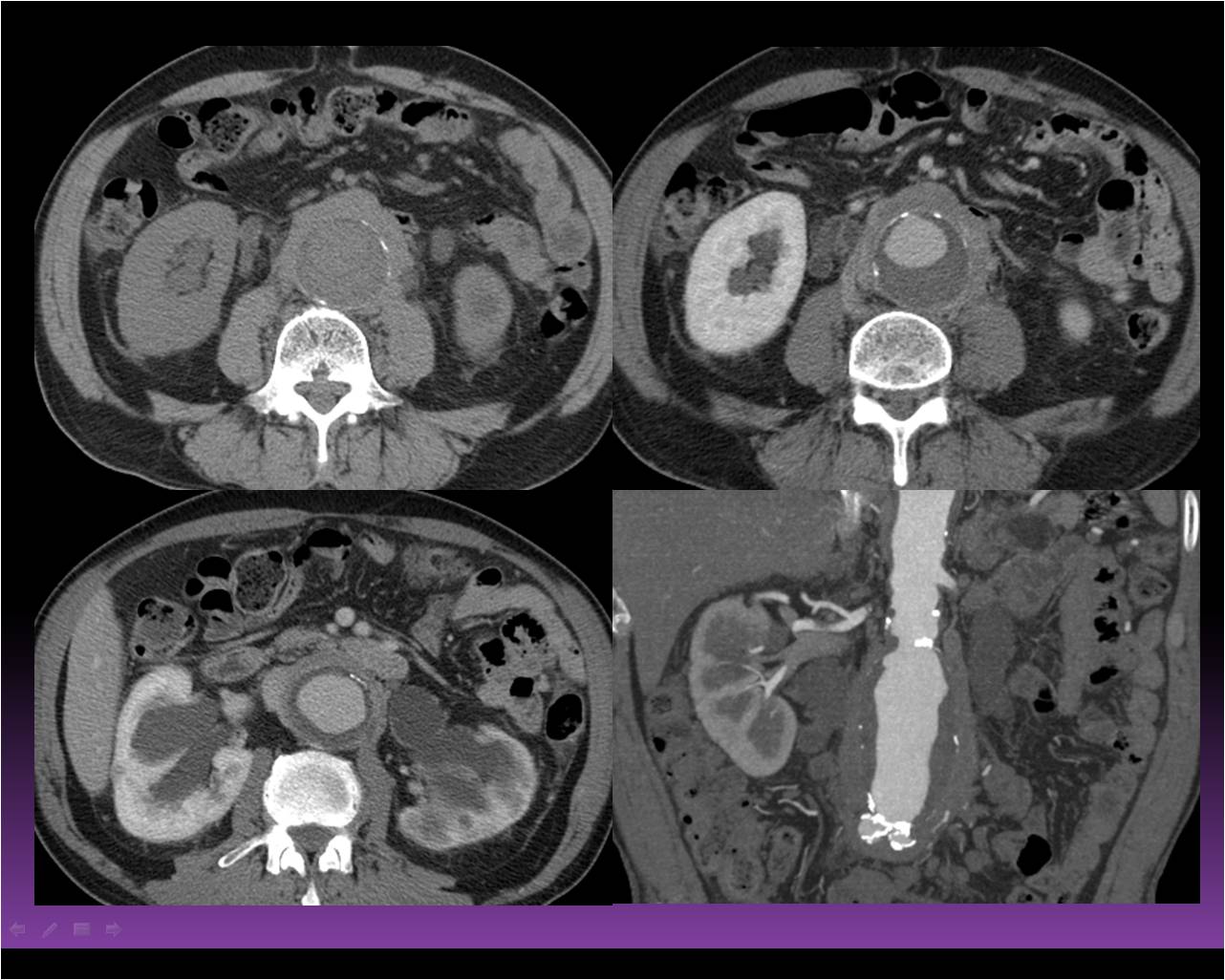 Aorta & pulmonary artery   66 / M,  Pulsatile abdominal mass