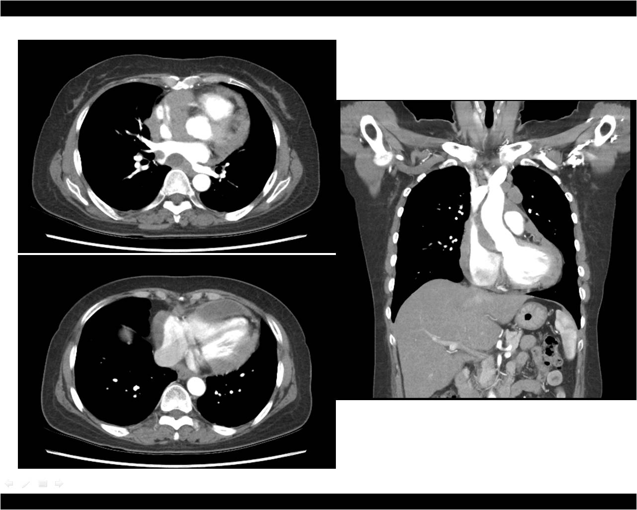 Heart   47 / F,  Dyspnea