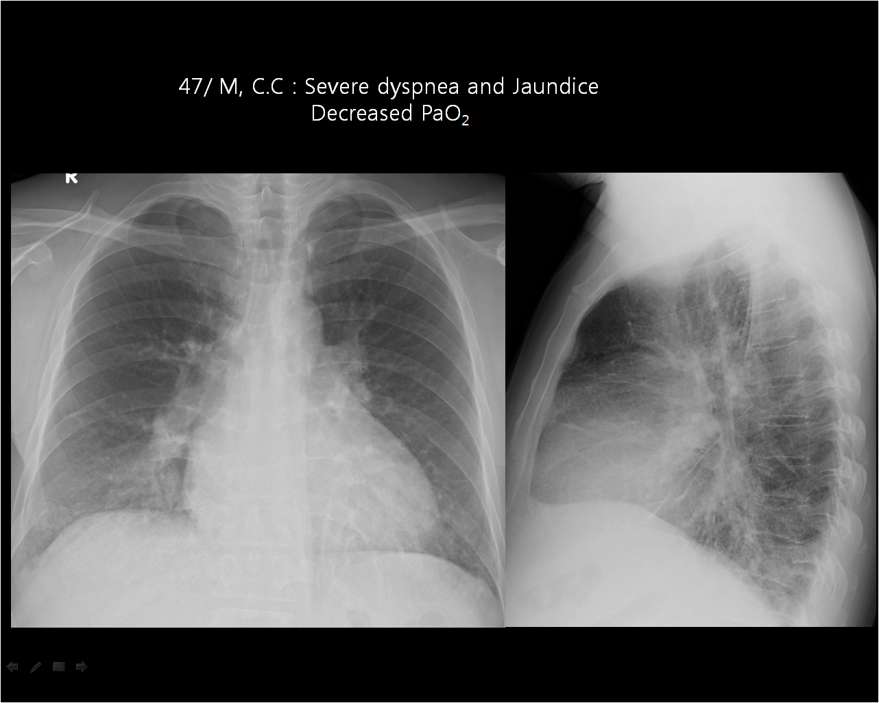 M/49, Severe dyspnea and Jaundice