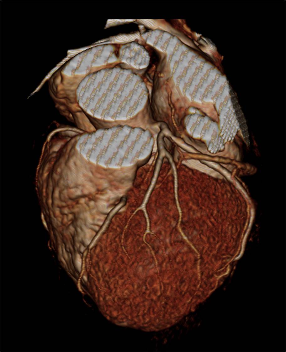 F/57, r/o angina equivalent