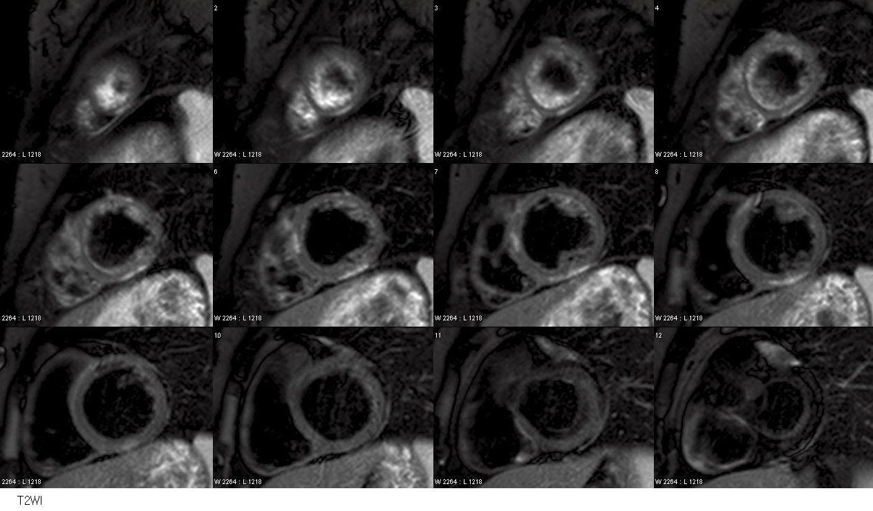 F/27<br> C.C.:  Acute Chest Pain (Known Vivax Malaria) / Cardiac Enzyme: Elevated/Outside CAG: Normal