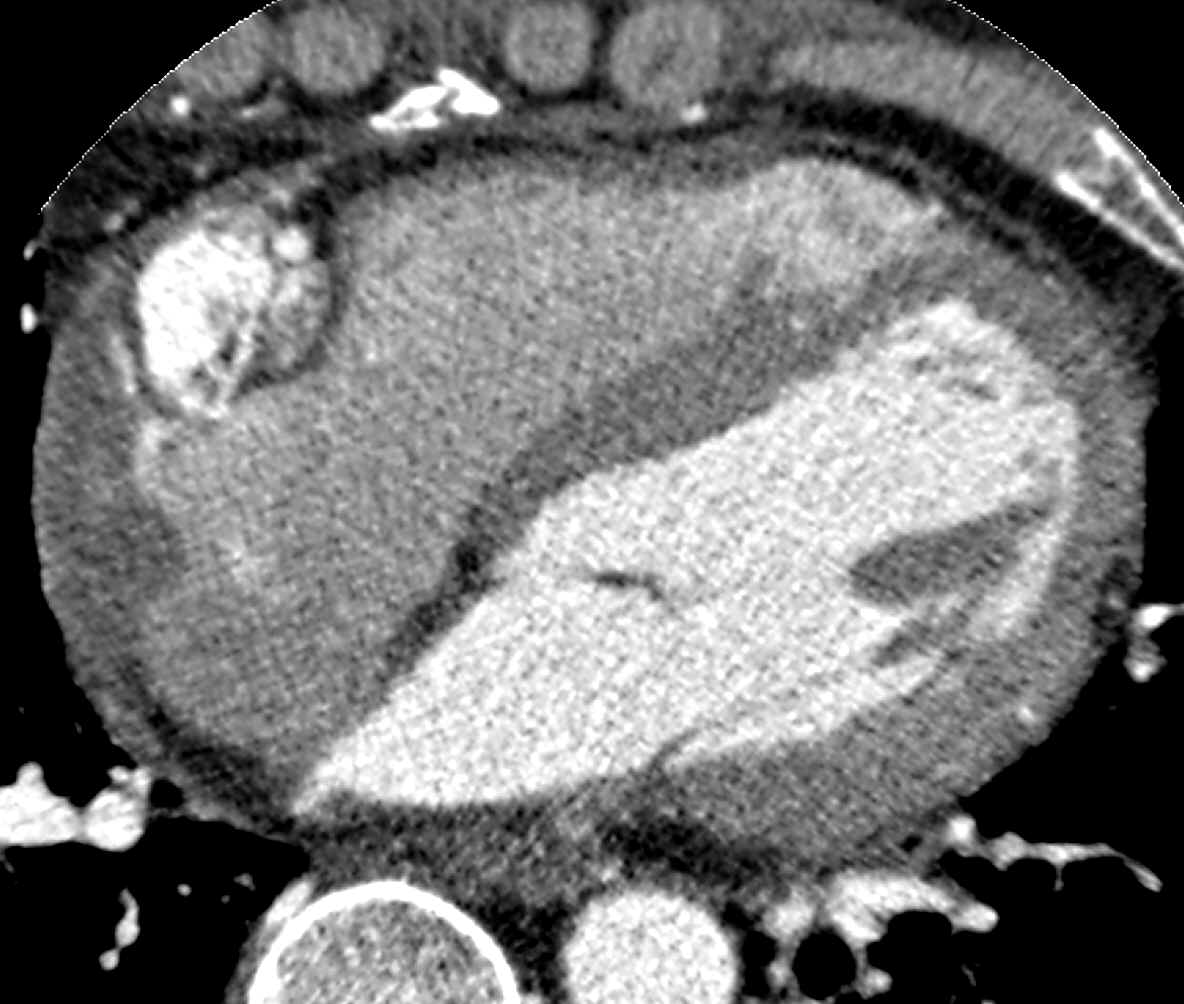 M/43 <Br>C.C.: Dyspnea on exertion after blunt trauma on chest wall, 4 months ago. Heart rate during MDCT was 73 bpm.