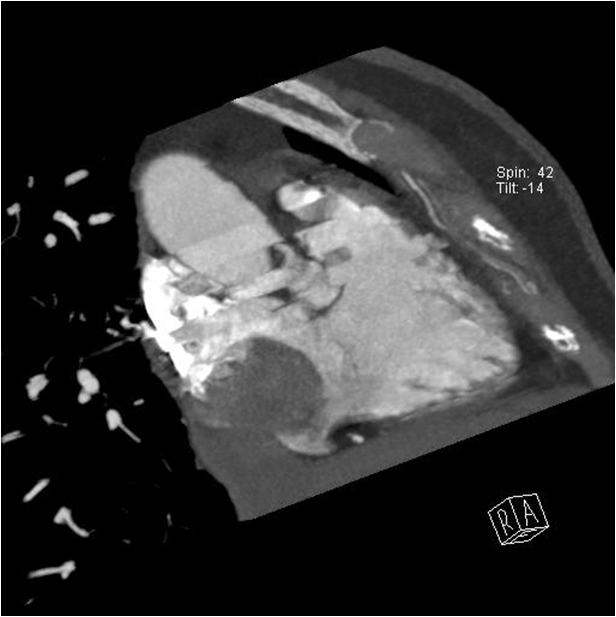 F/70<br>C.C. : Incidentally Cardiac Mass on Health Examination<br>PMH> HTN(+)<br>HR : 54-67-75