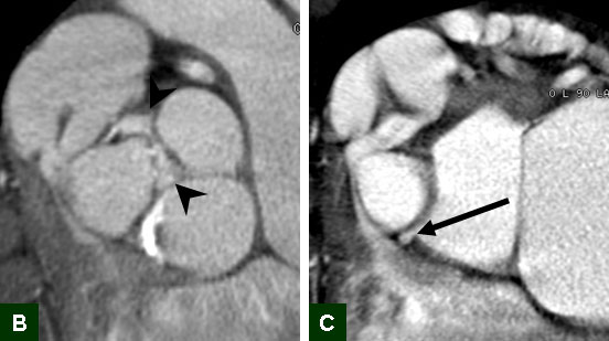 M/71, C.C: Chest pain on exercise (since 10 years ago)/ VSD history (+)