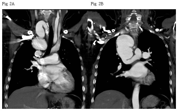 F/54, C.C: Abnormal chest x-ray