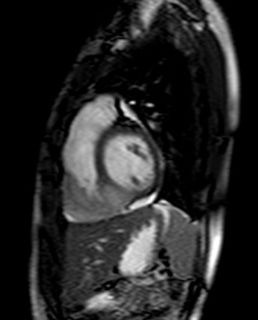 22yr / F, C.C. :  Chest pain for 5 years, Anterior, mid-chest area, Aggravated by exercise, improved by resting, Dizziness (+), Palpitation (+)