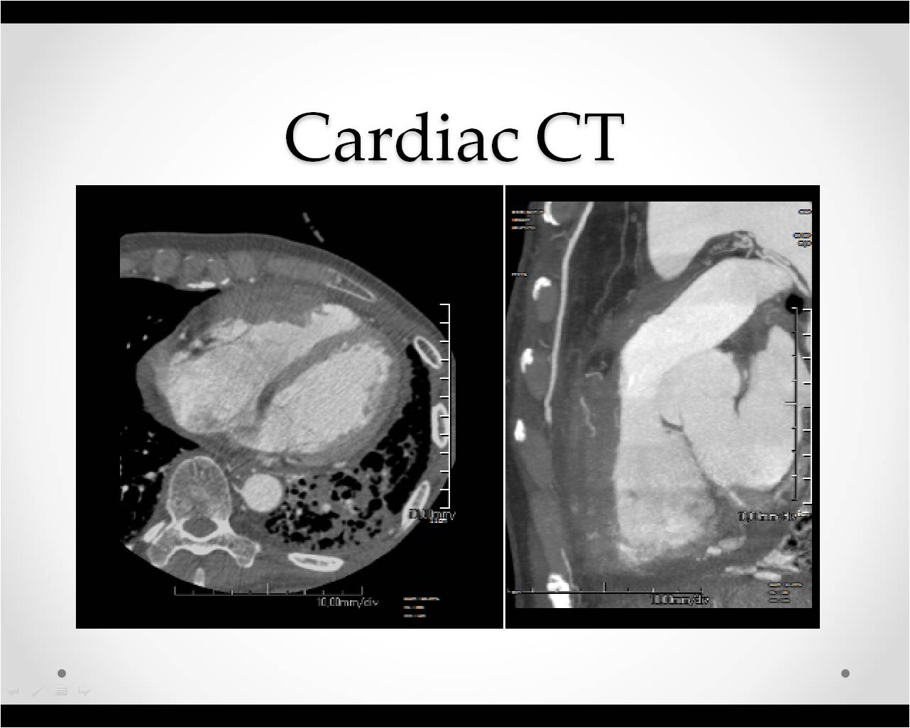 M/54, Dyspnea Aggravation for 1 Mo.