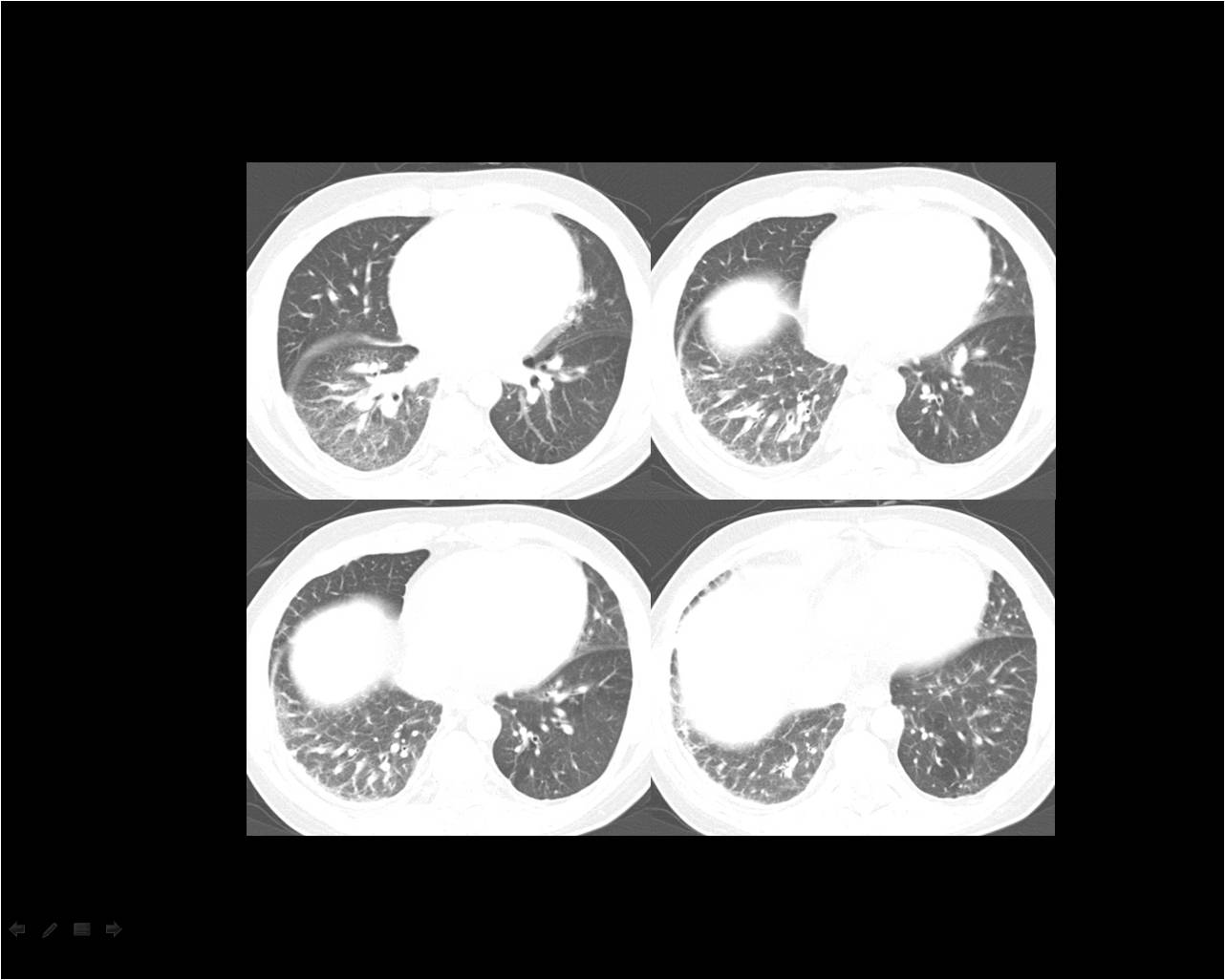 M/49, Severe dyspnea and Jaundice