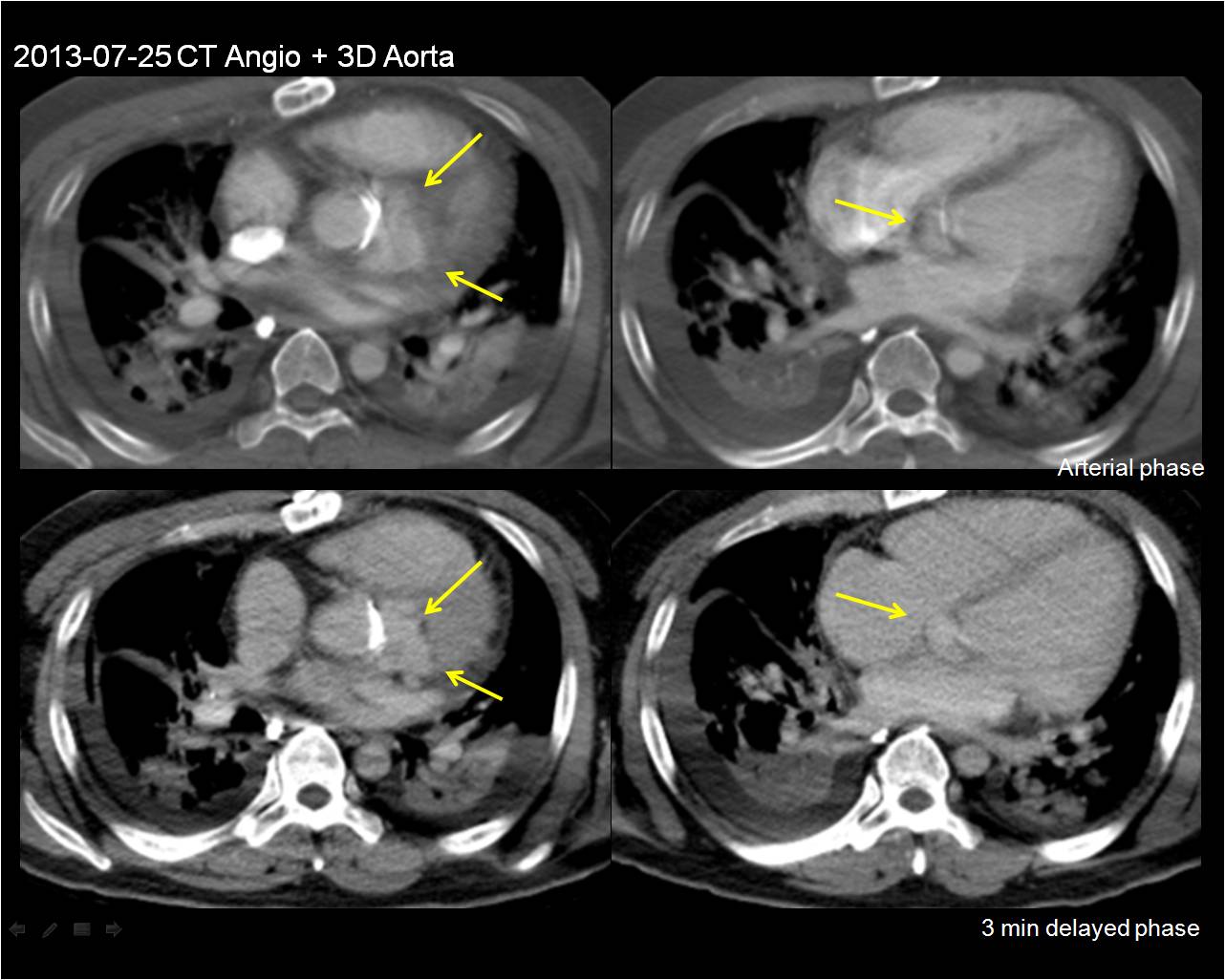 M/36 s/p AR, acute decompensated heart failure